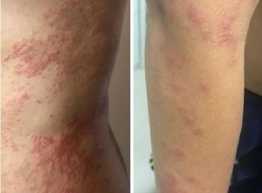  DERMATOSE EM SALVADOR